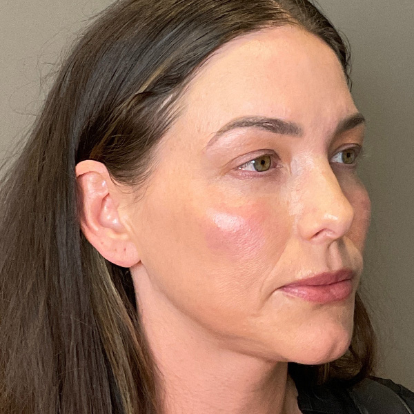 PRF EZ Gel Before & After Gallery - Patient 101880 - Image 4