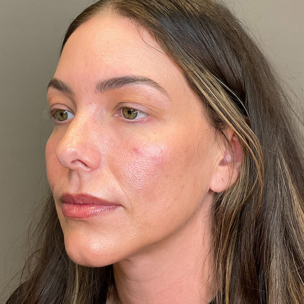 PRF EZ Gel Before & After Gallery - Patient 101880 - Image 5