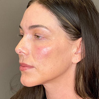 PRF EZ Gel Before & After Gallery - Patient 101880 - Image 6