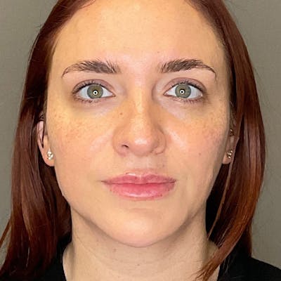 Facial Rejuvenation (Facial Balancing)  Before & After Gallery - Patient 540199 - Image 2