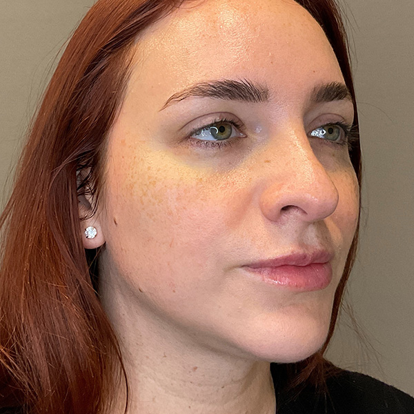 Facial Rejuvenation (Facial Balancing)  Before & After Gallery - Patient 540199 - Image 3