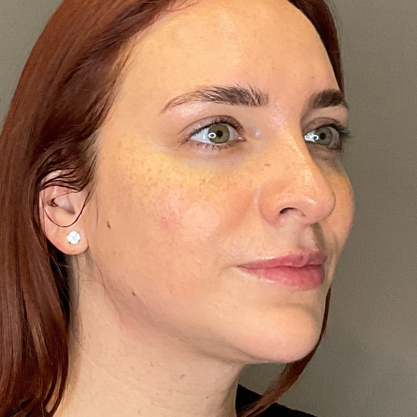 Facial Rejuvenation (Facial Balancing)  Before & After Gallery - Patient 540199 - Image 4
