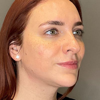 Facial Rejuvenation (Facial Balancing)  Before & After Gallery - Patient 540199 - Image 4