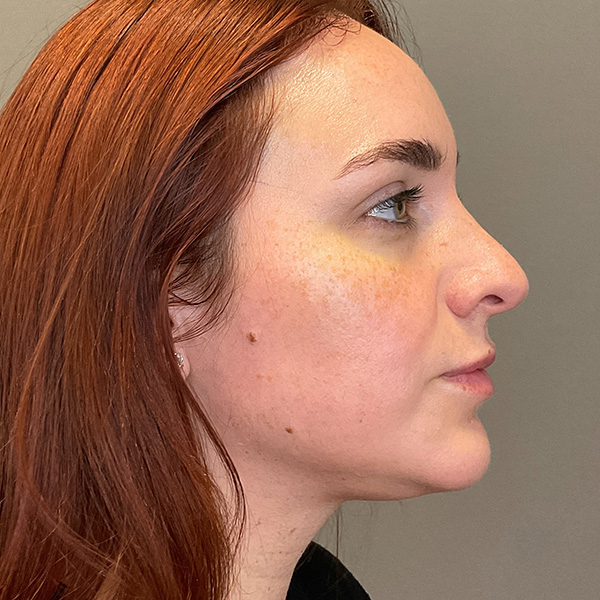 Facial Rejuvenation (Facial Balancing)  Before & After Gallery - Patient 540199 - Image 5