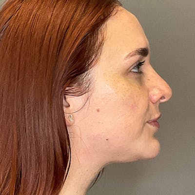 Facial Rejuvenation (Facial Balancing)  Before & After Gallery - Patient 540199 - Image 6