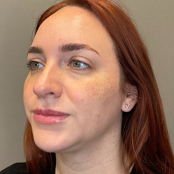 Facial Rejuvenation (Facial Balancing)  Before & After Gallery - Patient 540199 - Image 7