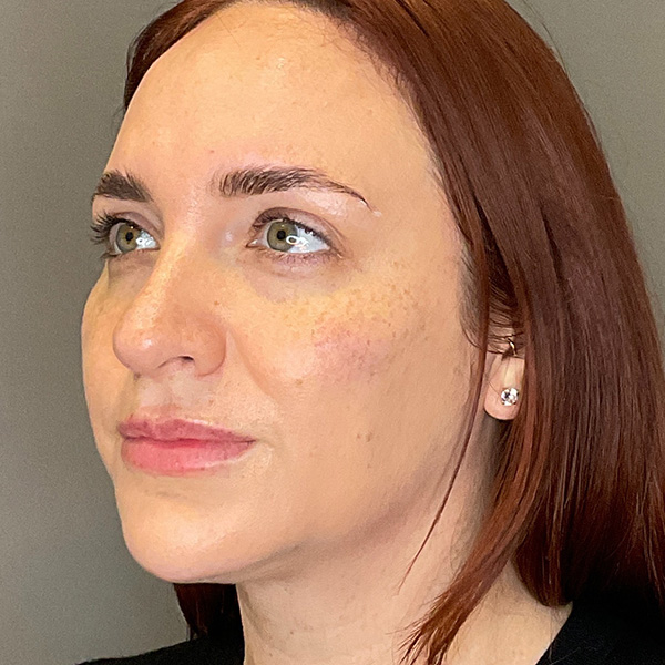 Facial Rejuvenation (Facial Balancing)  Before & After Gallery - Patient 540199 - Image 8