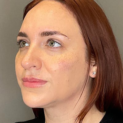 Facial Rejuvenation (Facial Balancing)  Before & After Gallery - Patient 540199 - Image 8