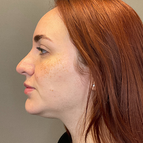Facial Rejuvenation (Facial Balancing)  Before & After Gallery - Patient 540199 - Image 9
