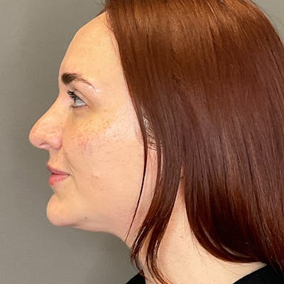 Facial Rejuvenation (Facial Balancing)  Before & After Gallery - Patient 540199 - Image 10