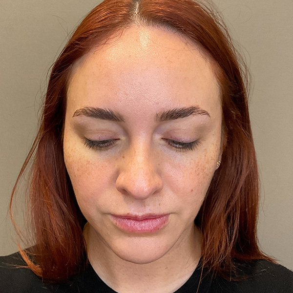 Facial Rejuvenation (Facial Balancing)  Before & After Gallery - Patient 540199 - Image 11