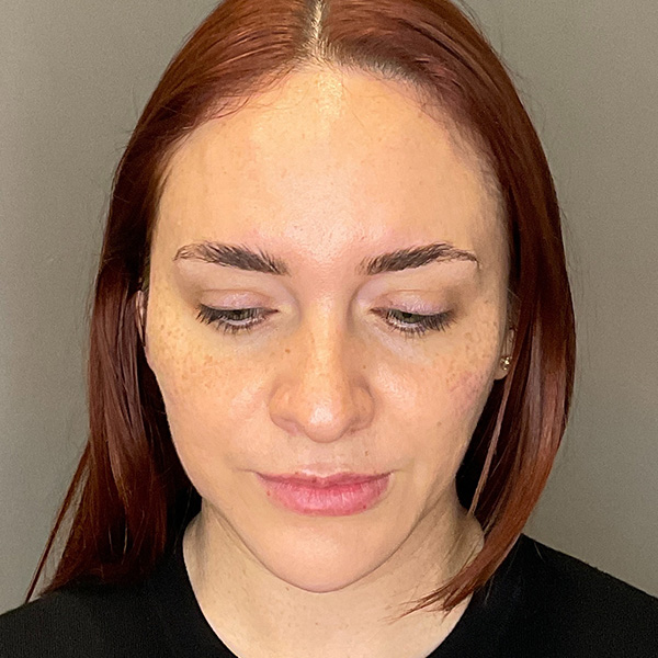 Facial Rejuvenation (Facial Balancing)  Before & After Gallery - Patient 540199 - Image 12