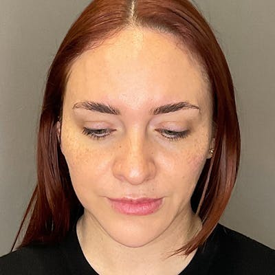Facial Rejuvenation (Facial Balancing)  Before & After Gallery - Patient 540199 - Image 12