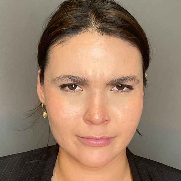 BOTOX Before & After Gallery - Patient 186322 - Image 3