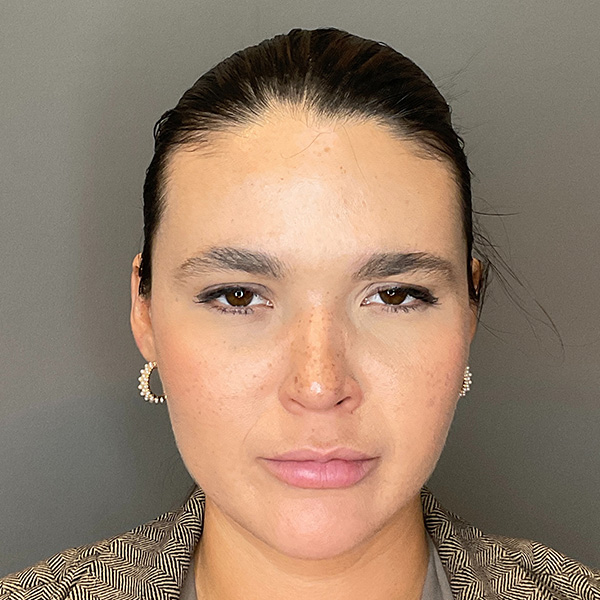 BOTOX Before & After Gallery - Patient 186322 - Image 4