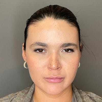 BOTOX Before & After Gallery - Patient 186322 - Image 4
