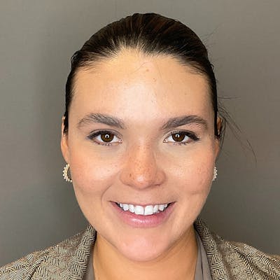 BOTOX Before & After Gallery - Patient 186322 - Image 6