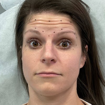 BOTOX Before & After Gallery - Patient 772755 - Image 1