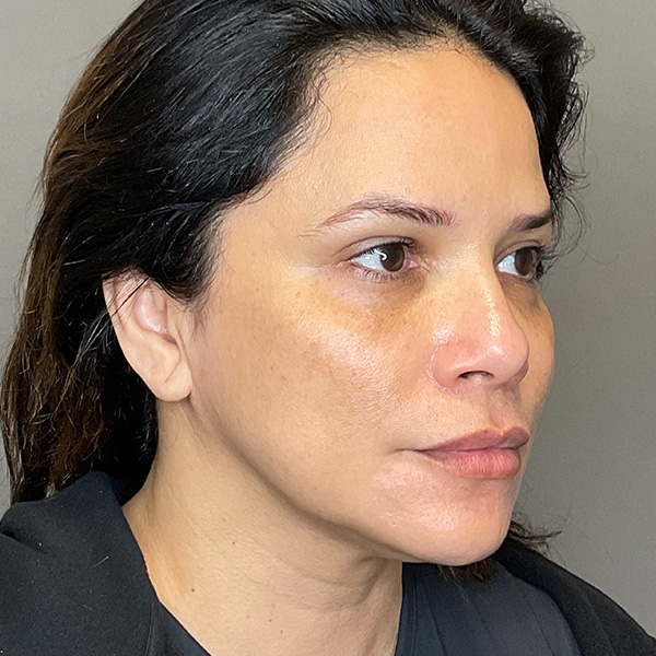Lipo-dissolve Before & After Gallery - Patient 138923 - Image 3