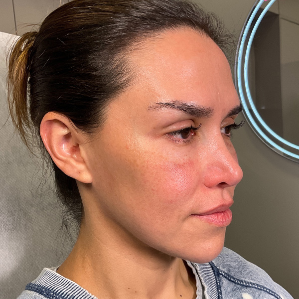 Sculptra Before & After Gallery - Patient 287469 - Image 3