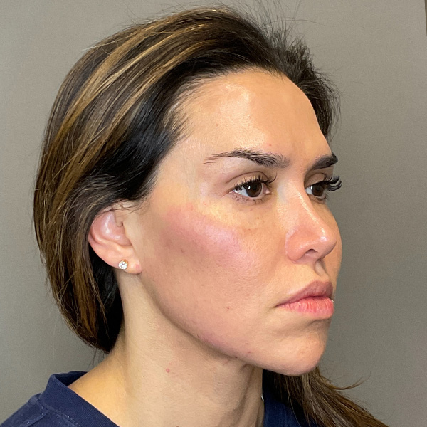 Sculptra Before & After Gallery - Patient 287469 - Image 4