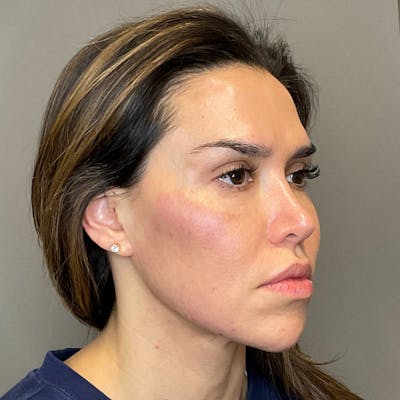 Sculptra Before & After Gallery - Patient 287469 - Image 4