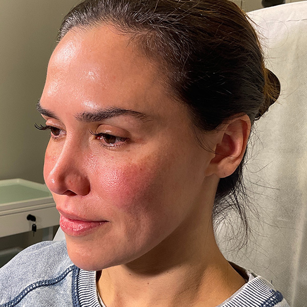 Sculptra Before & After Gallery - Patient 287469 - Image 5