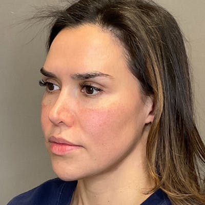 Sculptra Before & After Gallery - Patient 287469 - Image 6