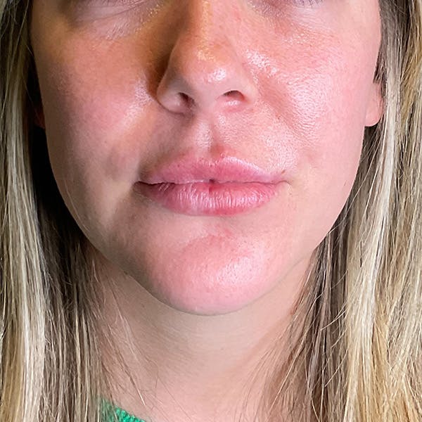 Lip Fillers Before & After Gallery - Patient 260827 - Image 1