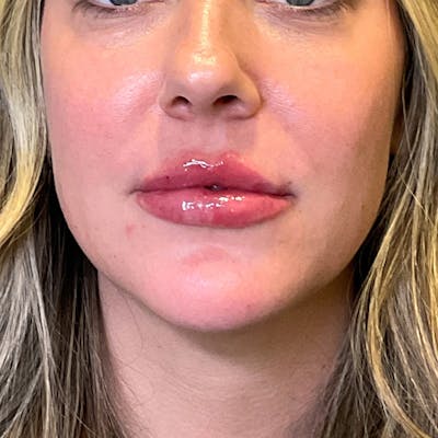 Lip Fillers Before & After Gallery - Patient 260827 - Image 8