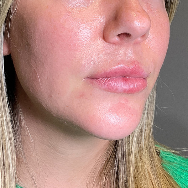 Lip Fillers Before & After Gallery - Patient 260827 - Image 3