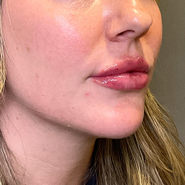 Lip Fillers Before & After Gallery - Patient 260827 - Image 10