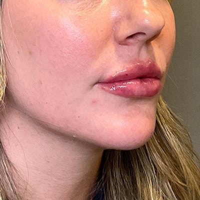 Lip Fillers Before & After Gallery - Patient 260827 - Image 10