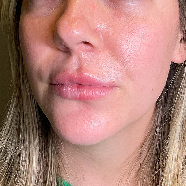 Lip Fillers Before & After Gallery - Patient 260827 - Image 5