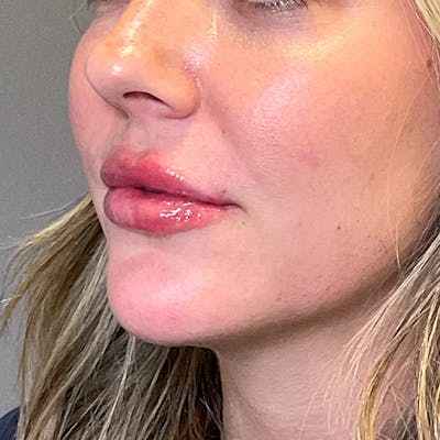 Lip Fillers Before & After Gallery - Patient 260827 - Image 12
