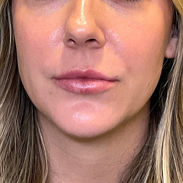 Lip Fillers Before & After Gallery - Patient 260827 - Image 2