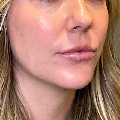 Lip Fillers Before & After Gallery - Patient 260827 - Image 4