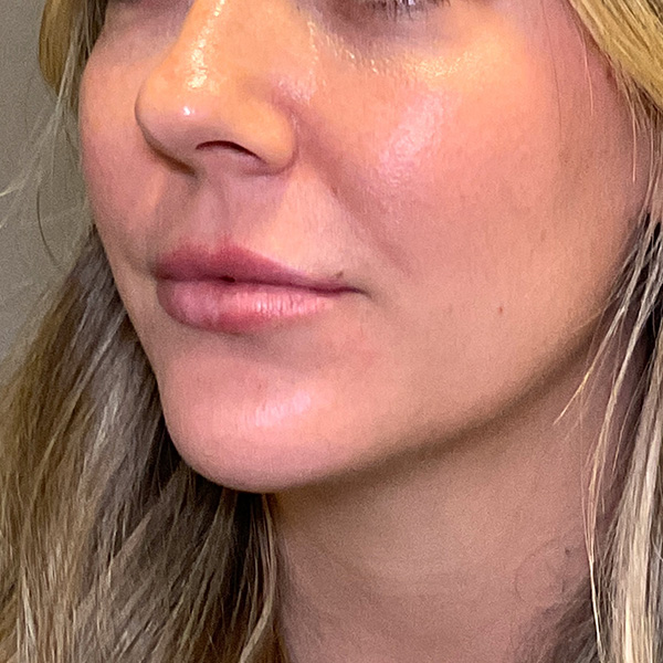 Lip Fillers Before & After Gallery - Patient 260827 - Image 6