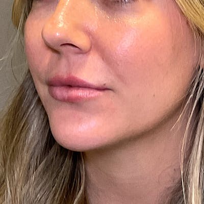 Lip Fillers Before & After Gallery - Patient 260827 - Image 6