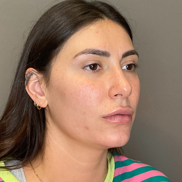 Facial Rejuvenation (Facial Balancing)  Before & After Gallery - Patient 290503 - Image 3