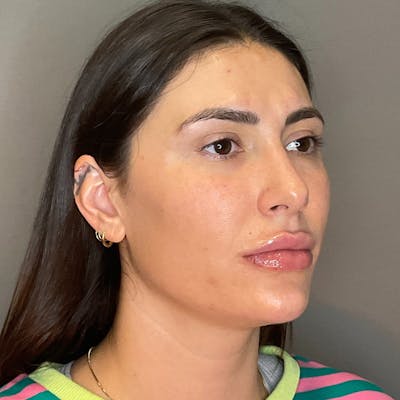 Facial Rejuvenation (Facial Balancing)  Before & After Gallery - Patient 290503 - Image 4