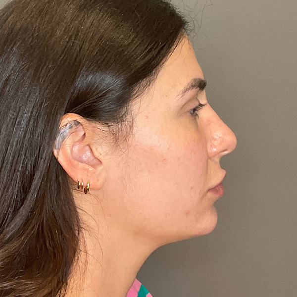 Facial Rejuvenation (Facial Balancing)  Before & After Gallery - Patient 290503 - Image 5