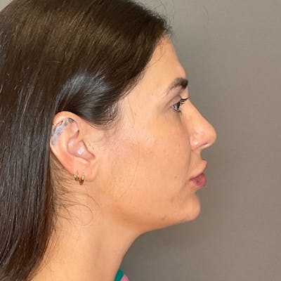 Facial Rejuvenation (Facial Balancing)  Before & After Gallery - Patient 290503 - Image 6