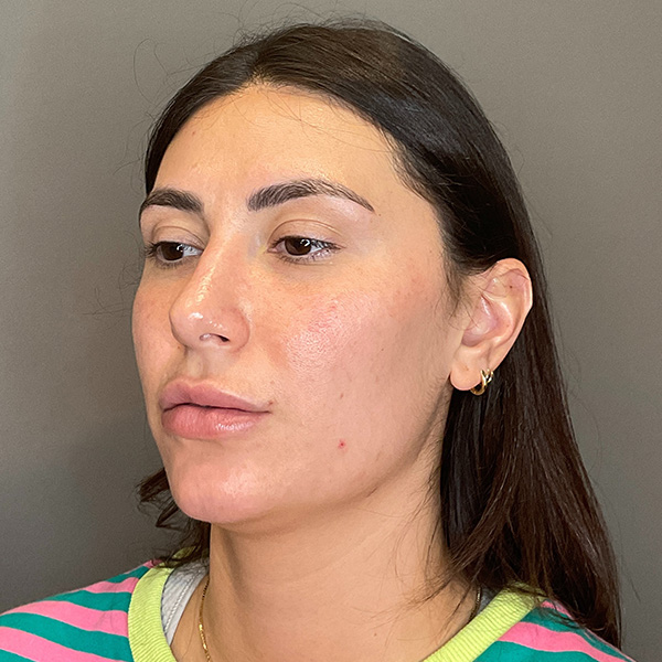 Facial Rejuvenation (Facial Balancing)  Before & After Gallery - Patient 290503 - Image 7