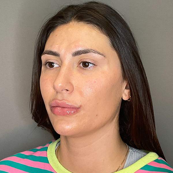 Facial Rejuvenation (Facial Balancing)  Before & After Gallery - Patient 290503 - Image 8