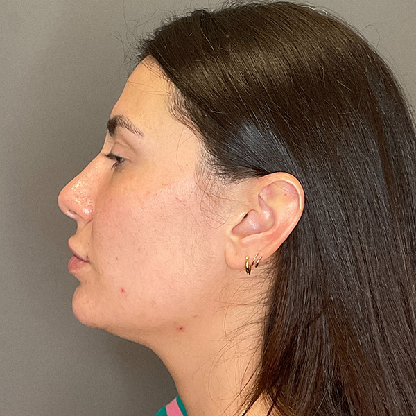 Facial Rejuvenation (Facial Balancing)  Before & After Gallery - Patient 290503 - Image 9