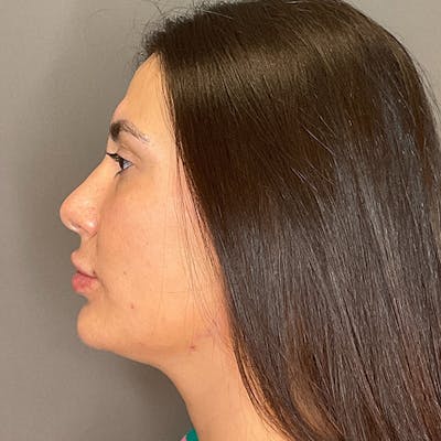 Facial Rejuvenation (Facial Balancing)  Before & After Gallery - Patient 290503 - Image 10