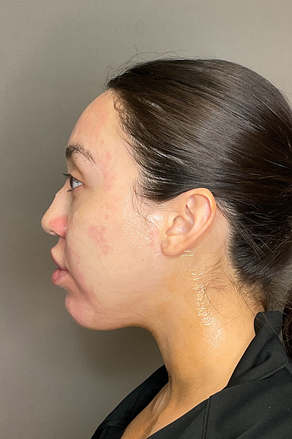 Morpheus8 Before & After Gallery - Patient 297473 - Image 3