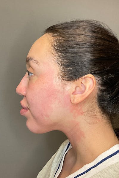 Morpheus8 Before & After Gallery - Patient 297473 - Image 4