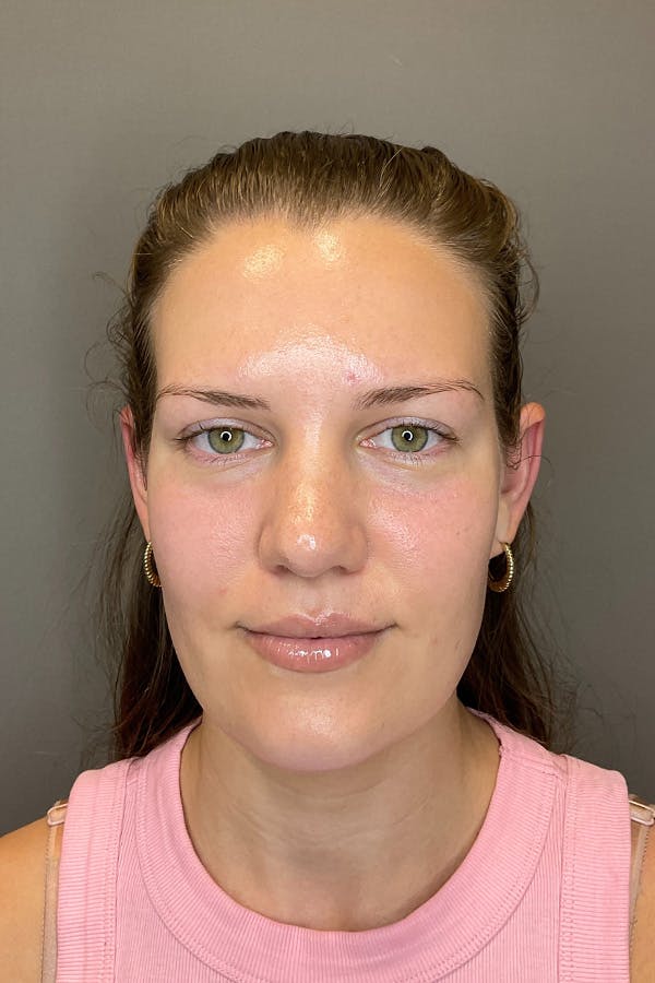 Hydrafacial Before & After Gallery - Patient 128836 - Image 2